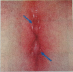 赤ちゃんの切れ痔、見張りイボ | 小児科コラム | 秋山こどもクリニック